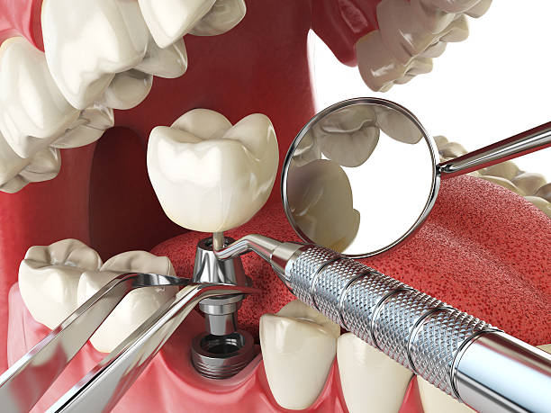 Best Broken or Cracked Tooth Emergency Dentist in Lebanon, IL